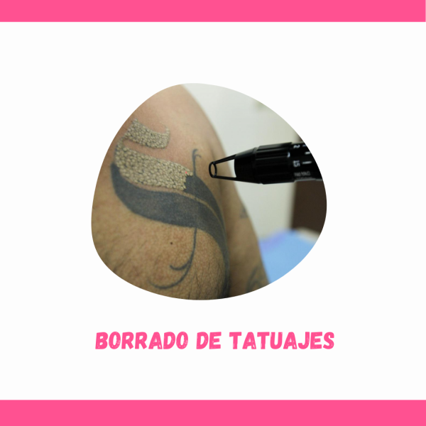 eliminación de tatuajes en Concepción con láser neodimio yag